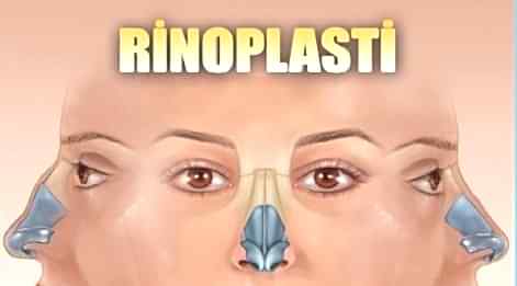 RİNOPLASTİ(ESTETİK BURUN AMELİYATI) SONRASI MALPRAKTİS İDDİASI İLE AÇILAN DAVADA ARAŞTIRILMASI GEREKEN HUSUSLAR.