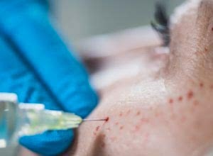 Güzellik Merkezinde PRP ve Dermapen ile cilt altı enjeksiyonu uygulanan olayda tazminat kararı