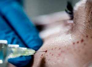 GÜZELLİK MERKEZİNDE YAPILAN DERMAPELLİ PRP VE BEN ALDIRMA İŞLEMİ SONRASINDA DAVACIDA MEYDANA GELEN KOMPLİKASYONLARIN HUKUKİ NİTELİĞİ (VAKA İNCELEMESİ)